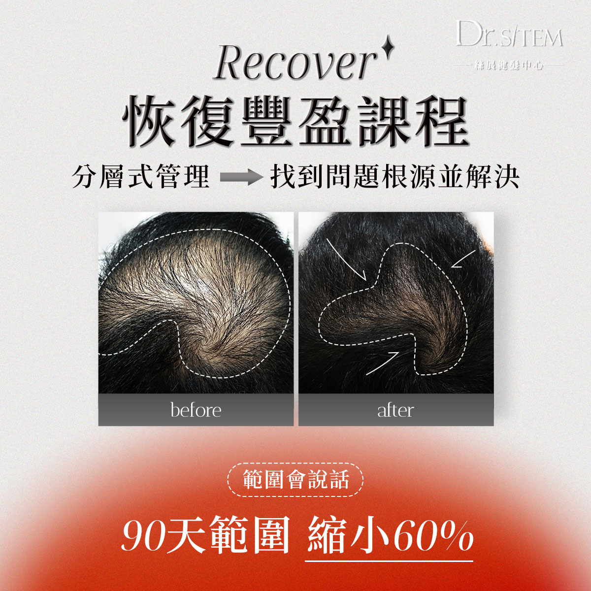 啟動毛囊的關鍵解密:Dr. Sitem絲展的自然生髮管理與頭皮毛囊檢測-生髮關鍵2
