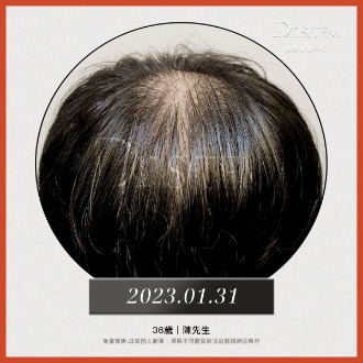 啟動毛囊的關鍵解密:Dr. Sitem絲展的自然生髮管理與頭皮毛囊檢測-恢復案例2